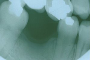 tilted teeth bridge molar orthodontics severely replace fixed